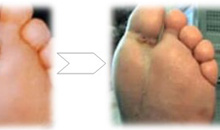 HBOT סוכרת רגל: רמז של תועלת סגירת פצע